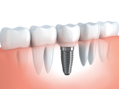 Implantologia dentale