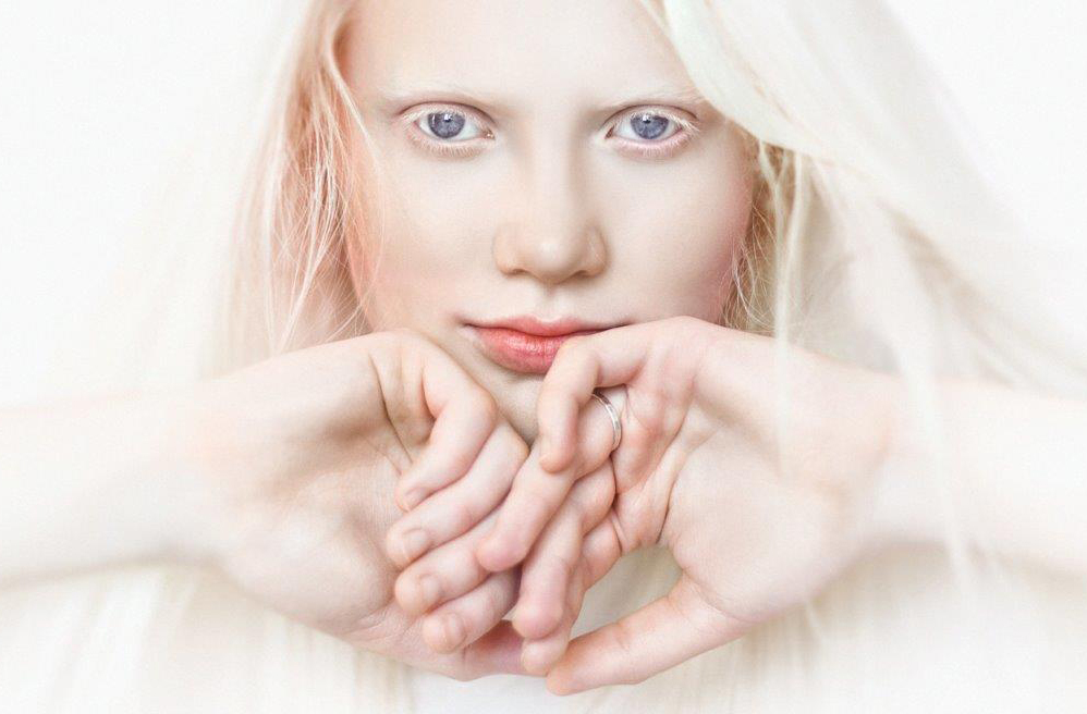 Albinismo